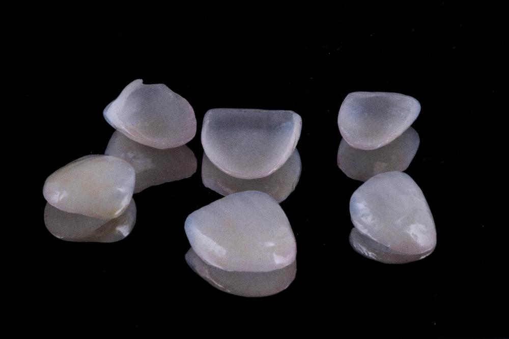 Porcelain Veeners in Birmingham, AL