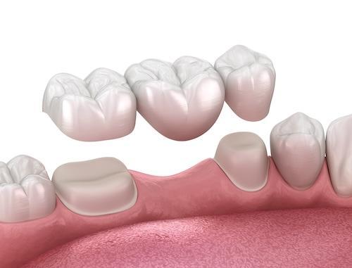 An illustration of Dental Crowns and Bridges in Birmingham, AL