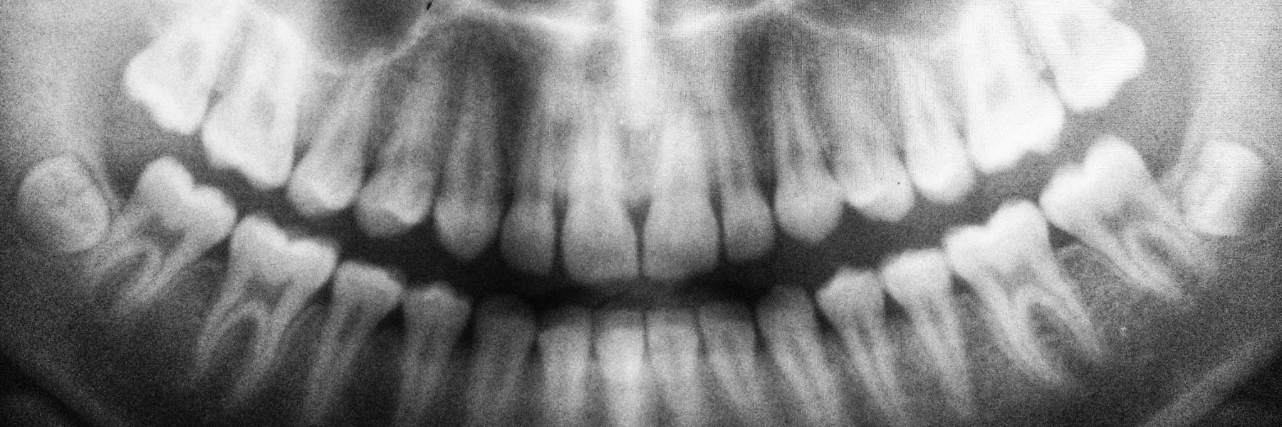 An x-ray picture of patient's teeth in Birmingham, AL