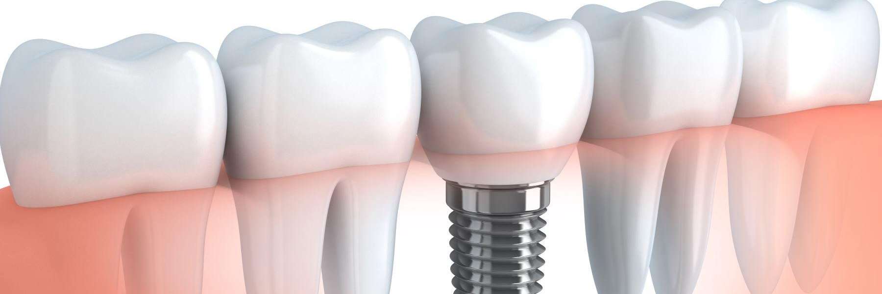 An illustration of a dental crown and implant in Birmingham, AL