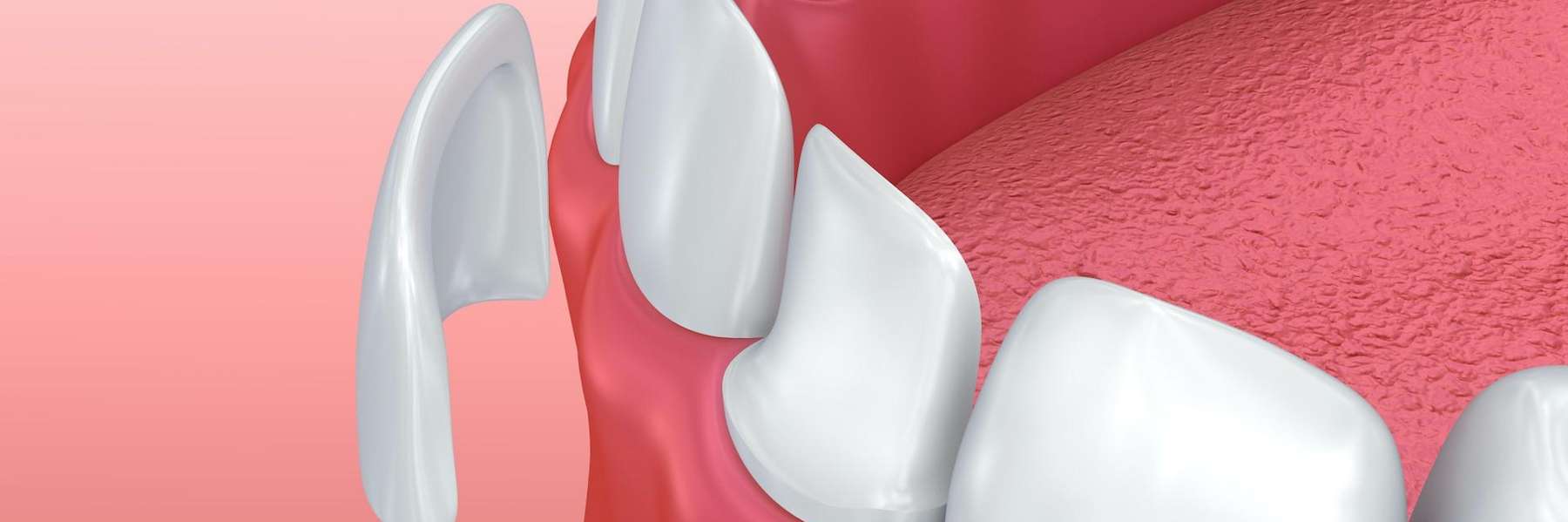 A graphic image of teeth showing veeners in Birmingham, Al