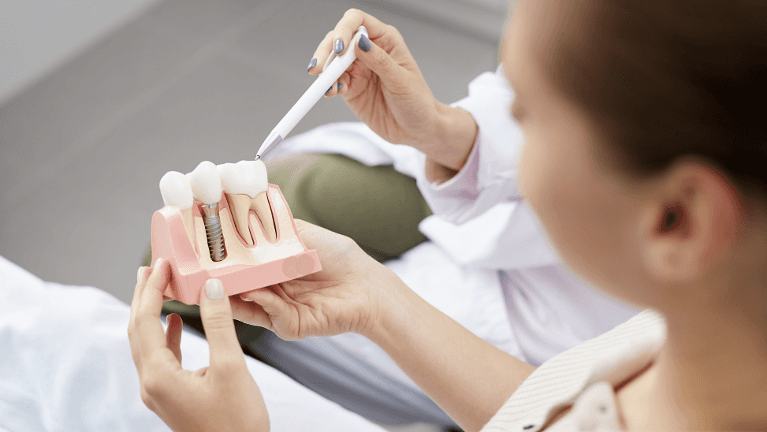 a model of a dental implants in Birmingham, AL