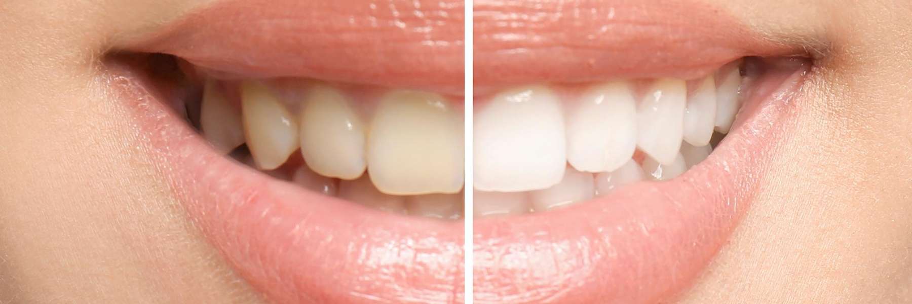 A before and after results of teeth whitening in Birmingham, AL
