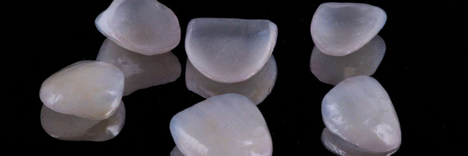 A photo of veneers in Birmingham, AL