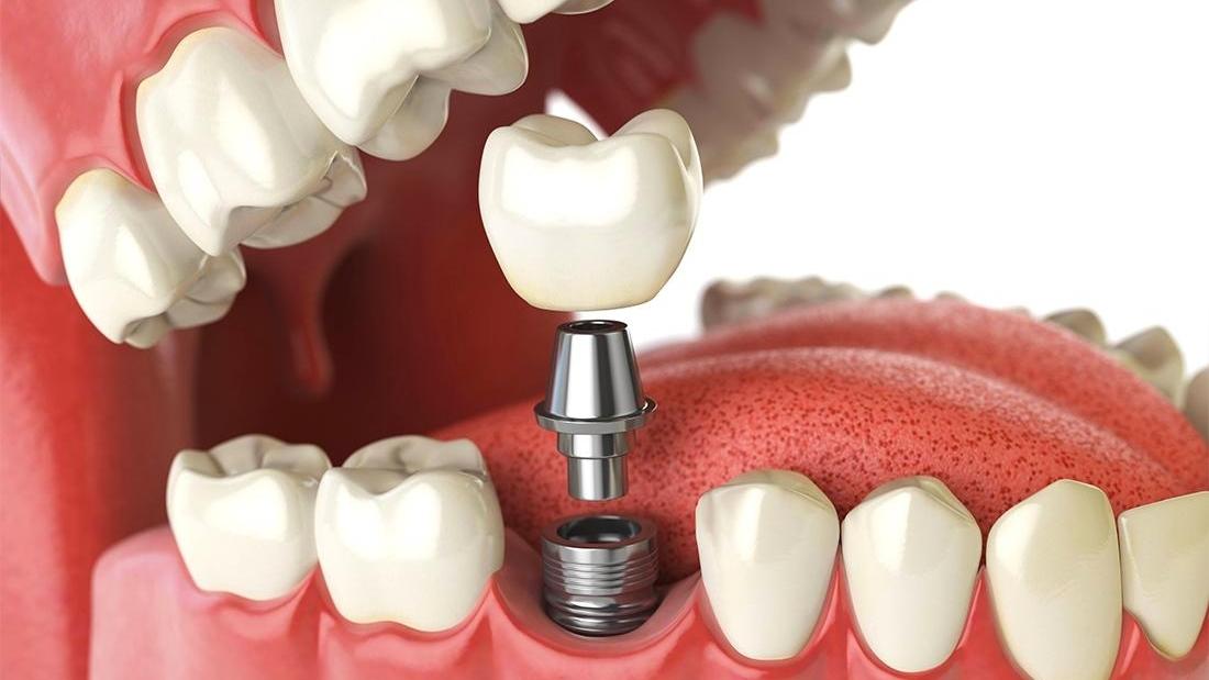 Birmingham Dental Implants What to Expect From Your Procedure