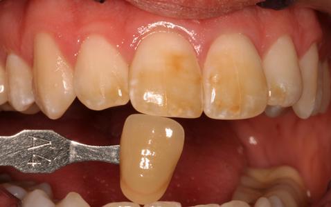 Stained yellowed teeth | Cook Family & Cosmetic Dentistry | Birmingham, AL