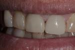 Repaired tooth wtih crown | Cook Family & Cosmetic Dentistry | Birmingham, AL