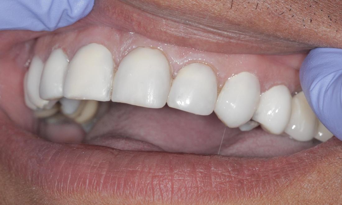 Cosmetic Bonding whitened teeth | Cook Family & Cosmetic Dentistry | Birmingham, AL
