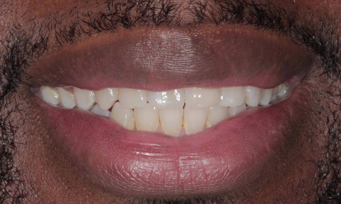 After ClearCorrect | Cook Family & Cosmetic Dentistry | Birmingham, AL