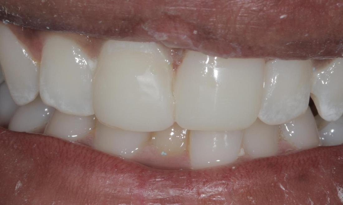 after repaired veneer | cook family dental | birmingham, al
