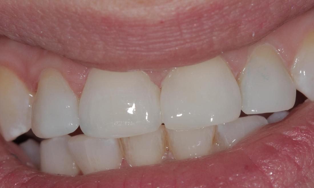 Cosmetic Bonding closes gaps | Cook Family & Cosmetic Dentistry | Birmingham, AL