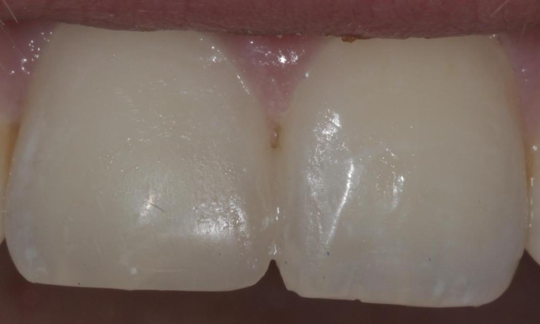Repaired tooth with bonding | Cook Family & Cosmetic Dentistry | Birmingham, AL