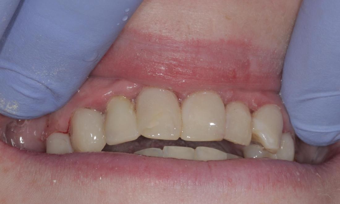 After cosmetic bonding | Cook Family & Cosmetic Dentistry | Birmingham, AL