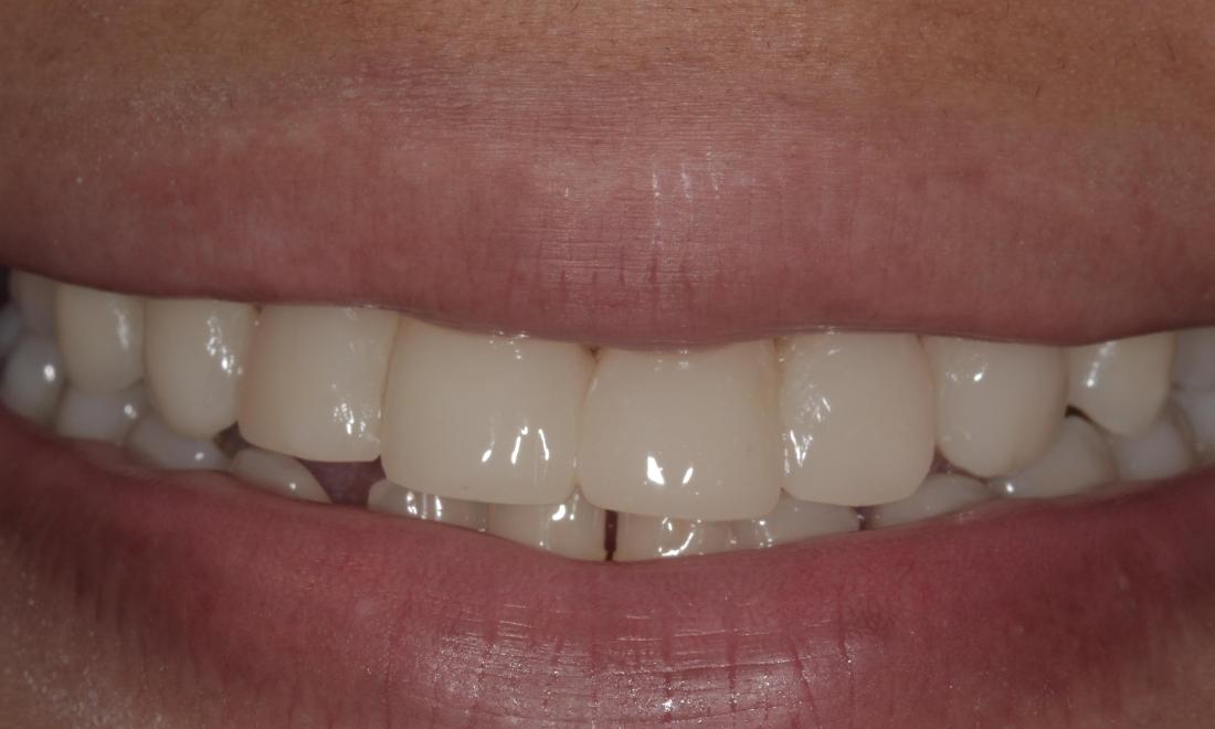 Cosmetic bonding closes gaps | Cook Family & Cosmetic Dentistry | Birmingham, AL