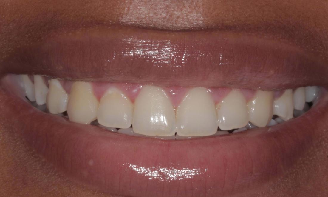 after gum re-shaping | Cook Family & Cosmetic Dentistry | Birmingham, AL