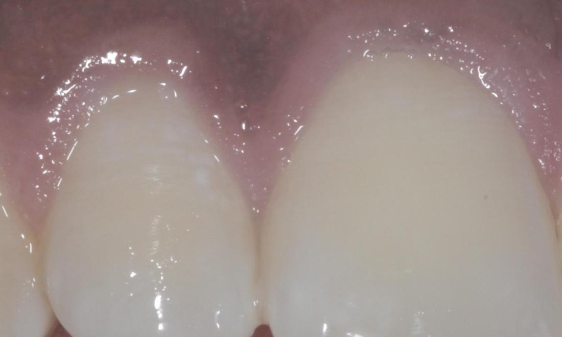 Spot removed with laser | Cook Family & Cosmetic Dentistry | Birmingham, AL