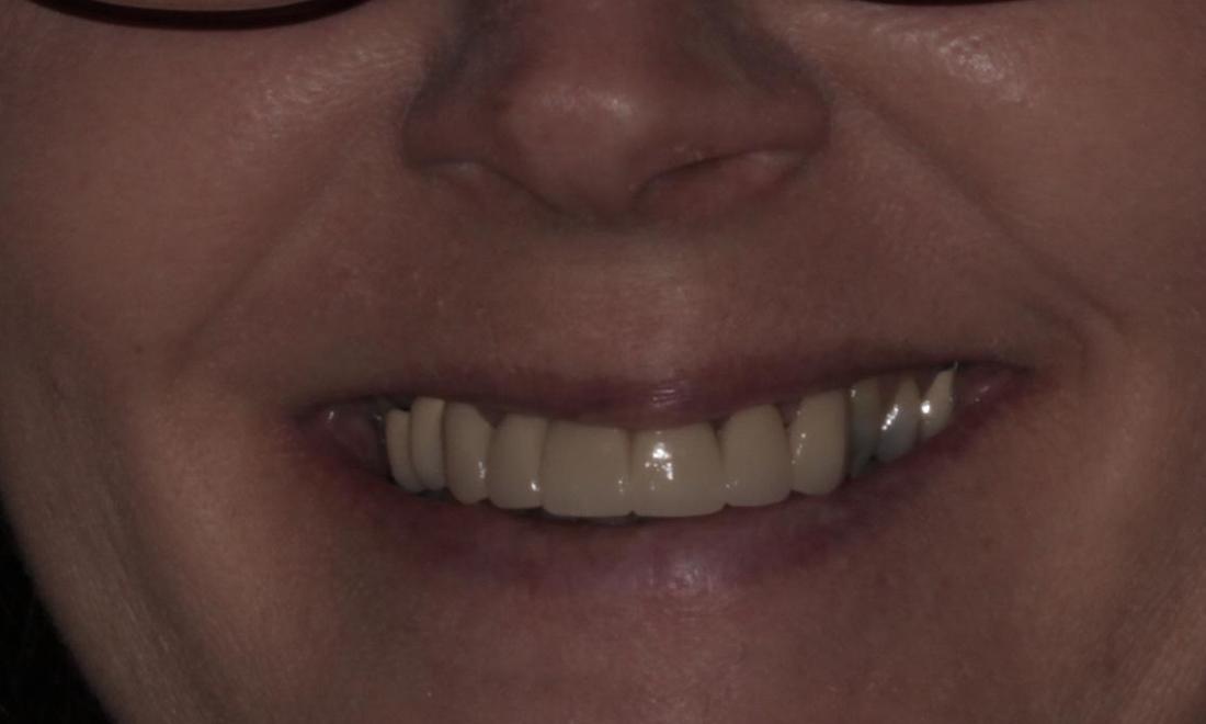 Porcelain Bridge After | Cook Family & Cosmetic Dentistry | Birmingham, AL