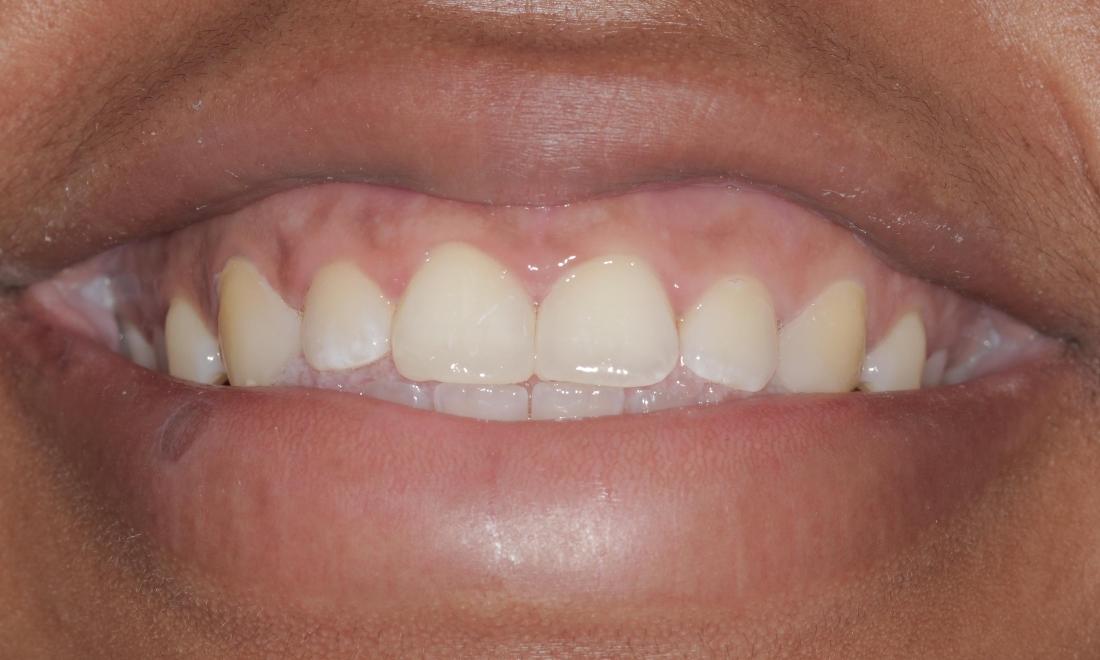 Space closed with cosmetic bonding | Cook Family & Cosmetic Dentistry | Birmingham, AL