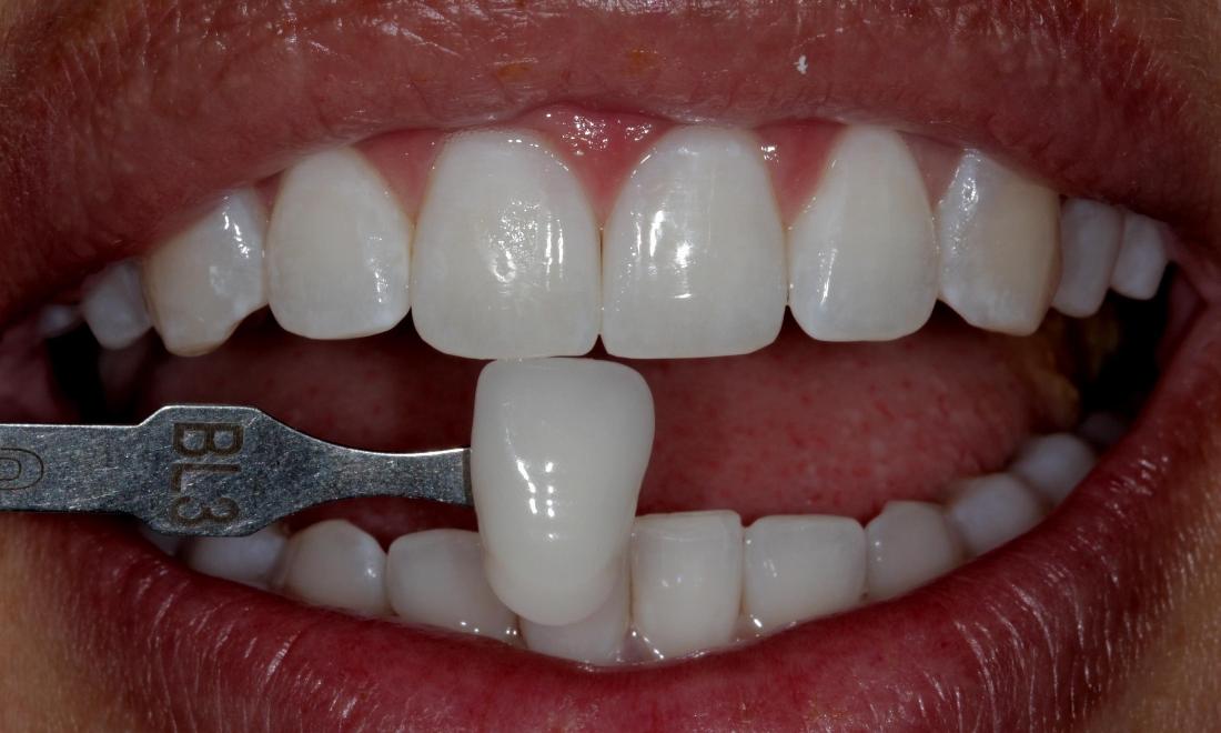 after Zoom! Whitening | Cook Family & Cosmetic Dentistry | Birmingham, AL