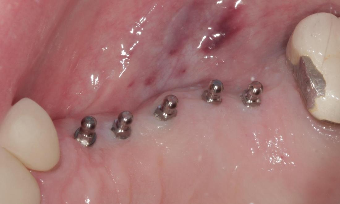 Dental implants | Cook Family & Cosmetic Dentistry | Birmingham, AL