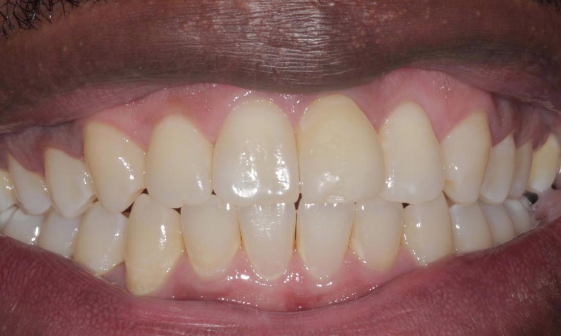 After ClearCorrect | Cook Family & Cosmetic Dentistry | Birmingham, AL
