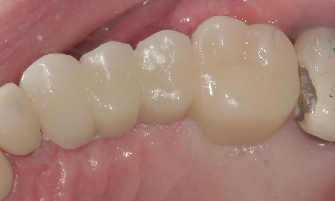 Dental implant placed | Cook Family & Cosmetic Dentistry | Birmingham, AL