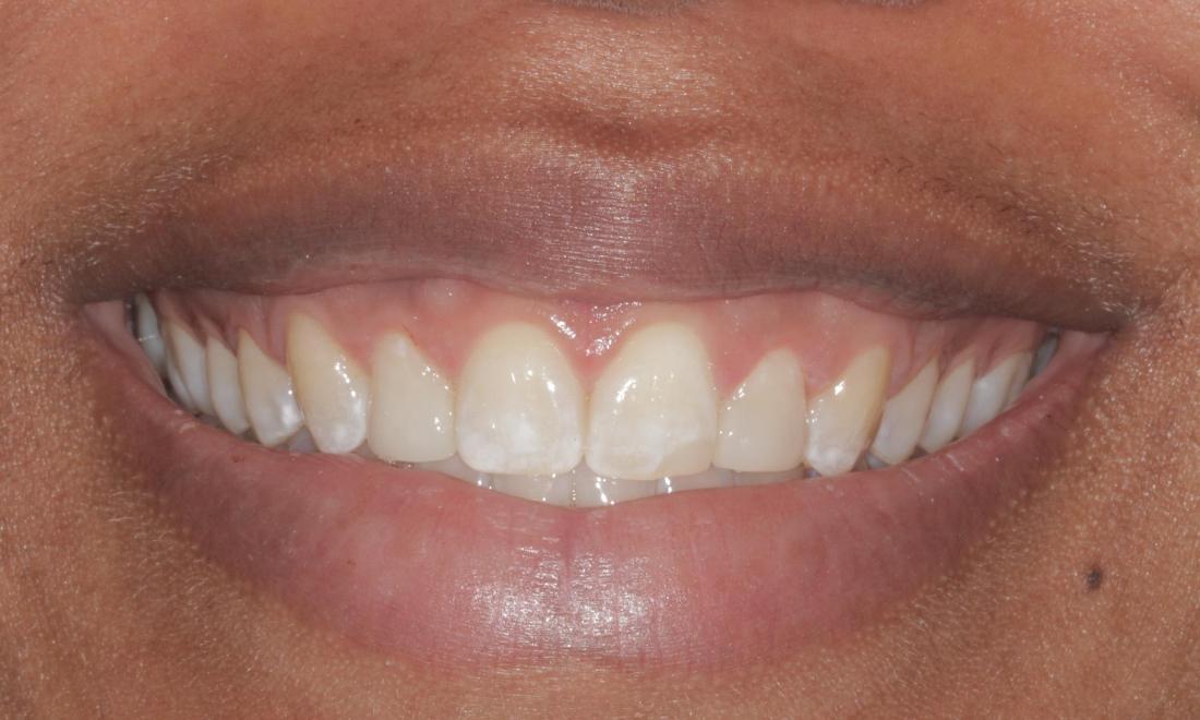 After cosmetic bonded veneers | Cook Family & Cosmetic Dentistry | Birmingham, AL