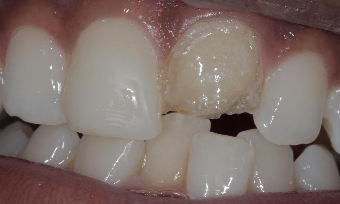 porcelain veneer removed | cook family dental | birmingham, al