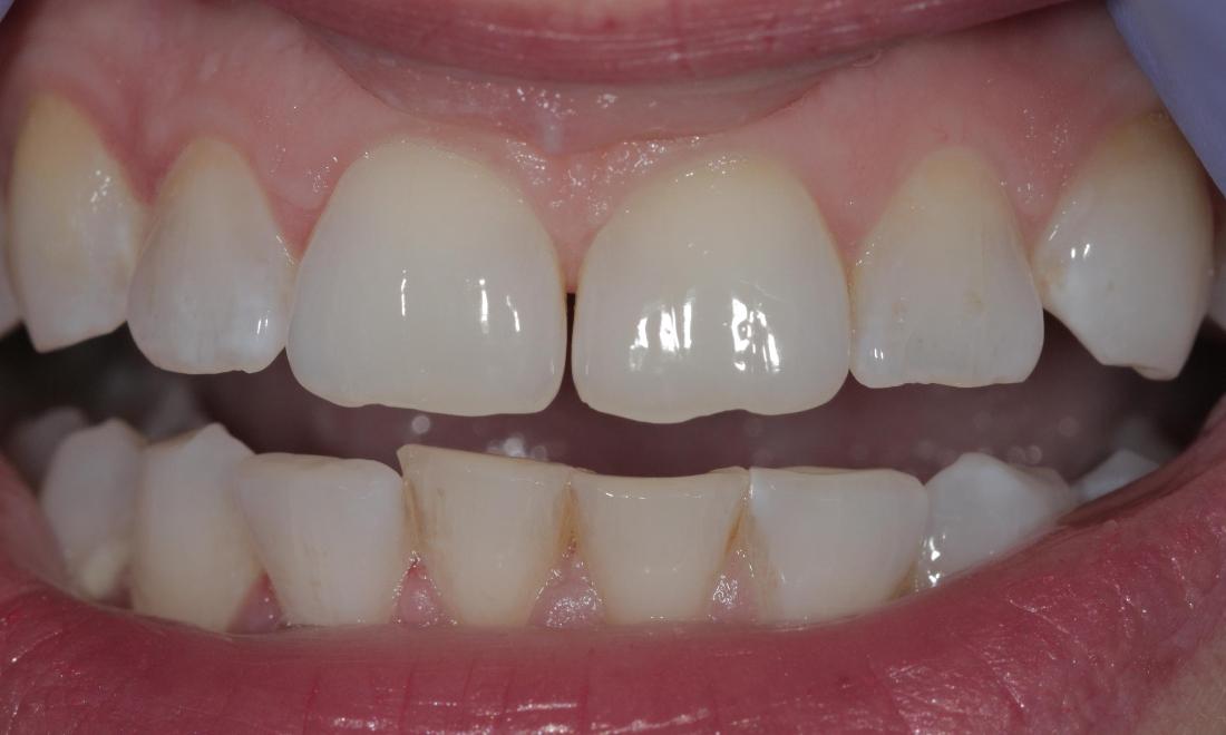 Gaps in teeth | Cook Family & Cosmetic Dentistry | Birmingham, AL
