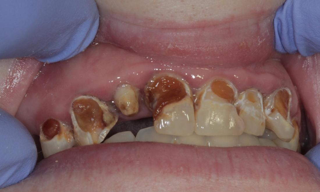 Cavities before | Cook Family & Cosmetic Dentistry | Birmingham, AL
