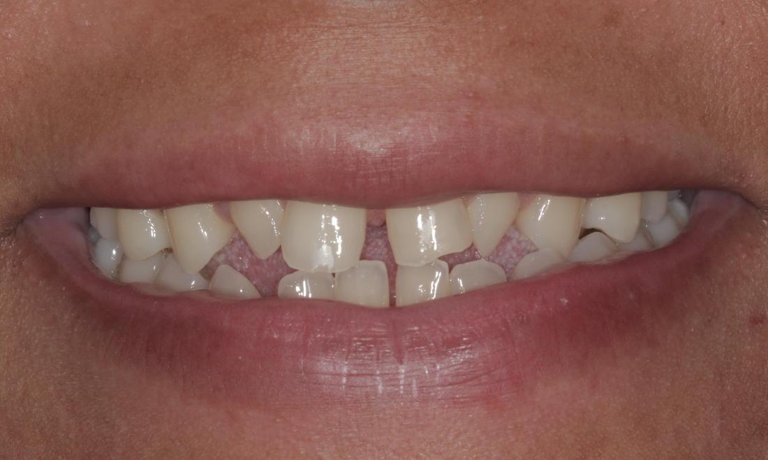 small teeth with gaps | Cook Family & Cosmetic Dentistry | Birmingham, AL