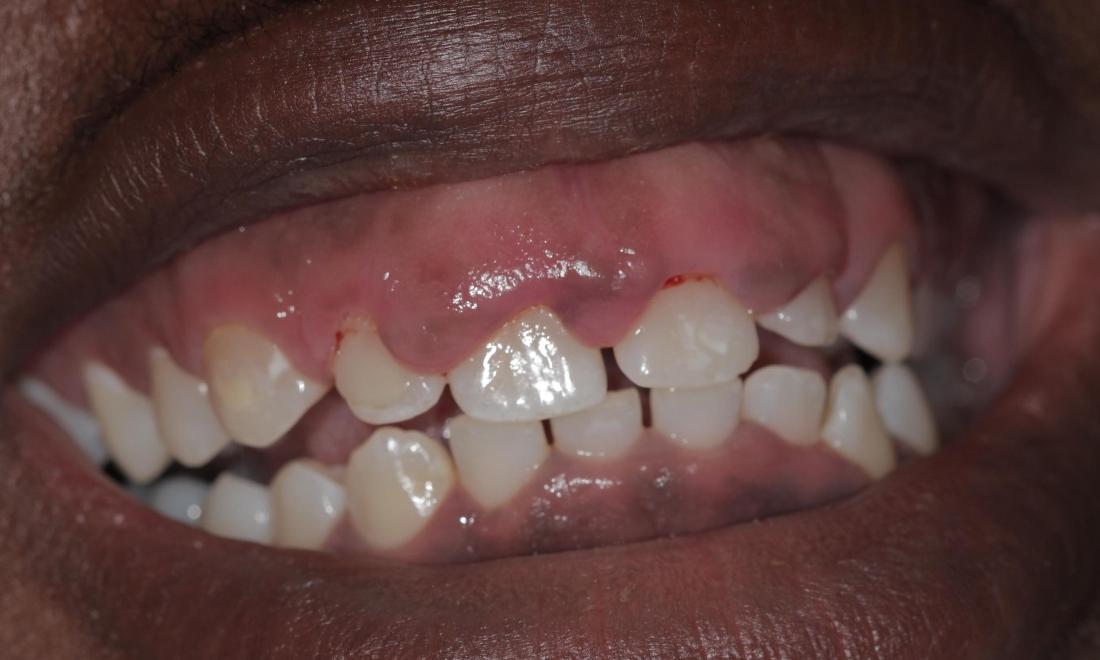 over-sized gums | Cook Family & Cosmetic Dentistry | Birmingham, AL