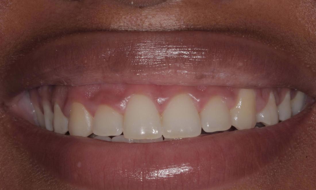 before gum re-shaping | Cook Family & Cosmetic Dentistry | Birmingham, AL