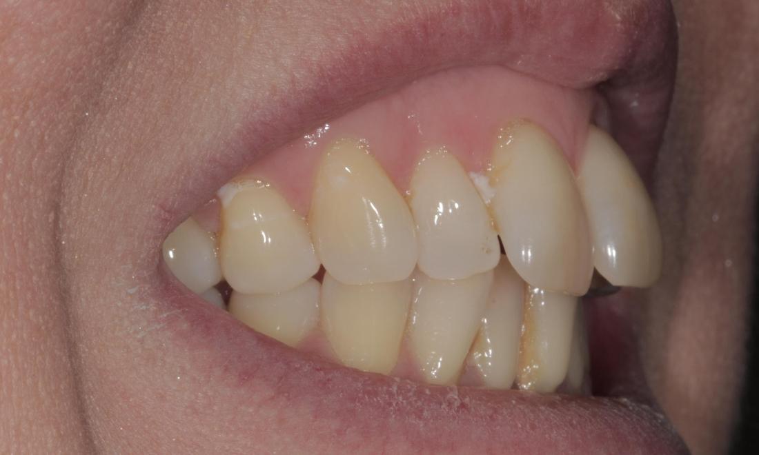 Buckteeth, yellow | Cook Family & Cosmetic Dentistry | Birmingham, AL