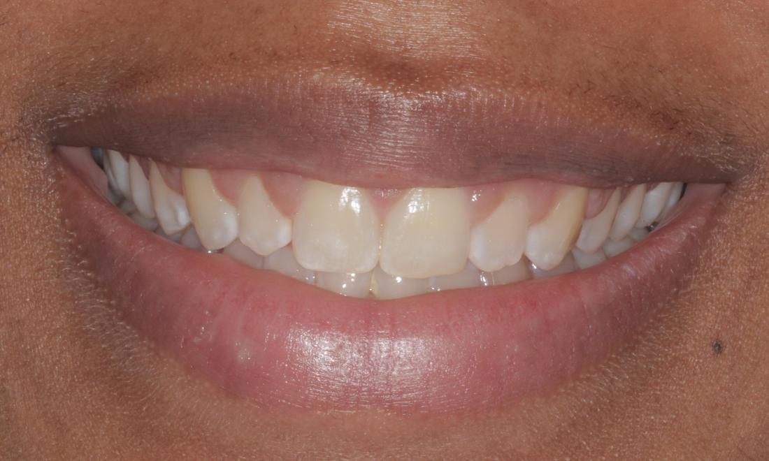 Before veneers | Cook Family & Cosmetic Dentistry | Birmingham, AL