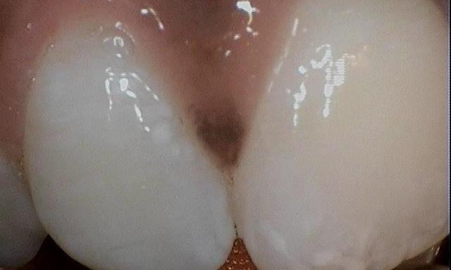 spotting on gums | Cook Family & Cosmetic Dentistry | Birmingham, AL
