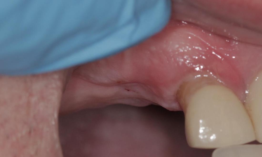 Missing tooth before | Cook Family & Cosmetic Dentistry | Birmingham, AL