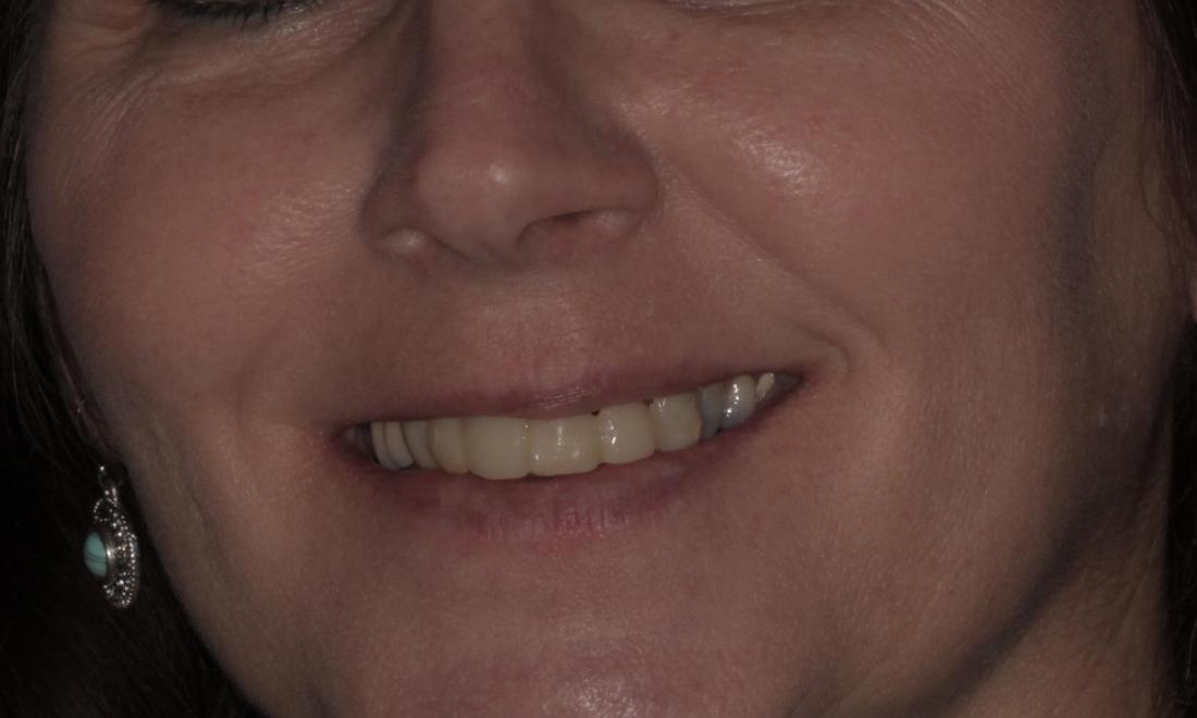 metal bridge before | Cook Family & Cosmetic Dentistry | Birmingham, AL