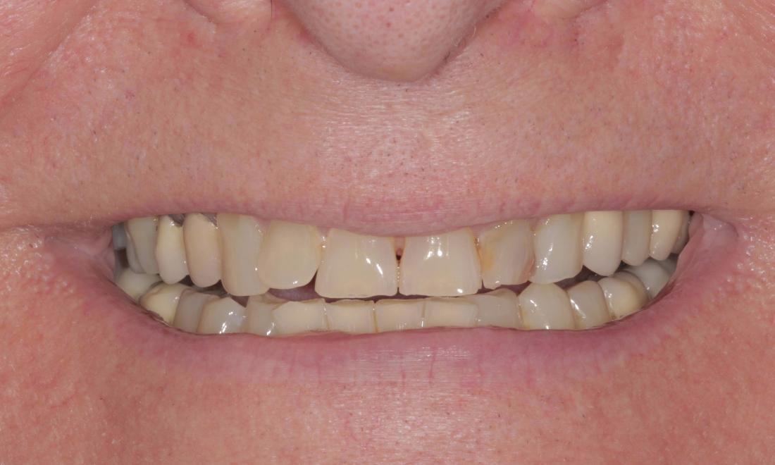 Before crowns and veneers | Cook Family & Cosmetic Dentistry | Birmingham, AL