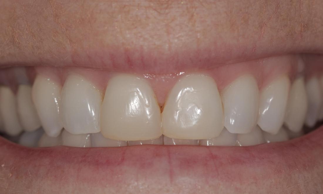 stained teeth | Cook Family & Cosmetic Dentistry | Birmingham, AL