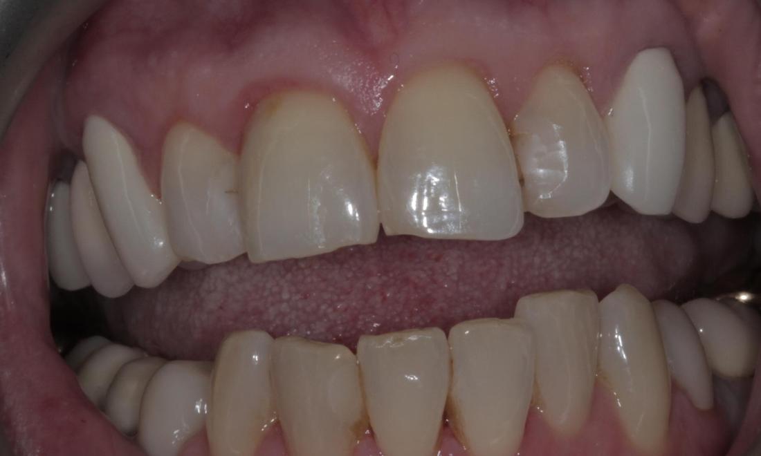 Chipped and Stained Teeth | Cook Family & Cosmetic Dentistry | Birmingham, AL