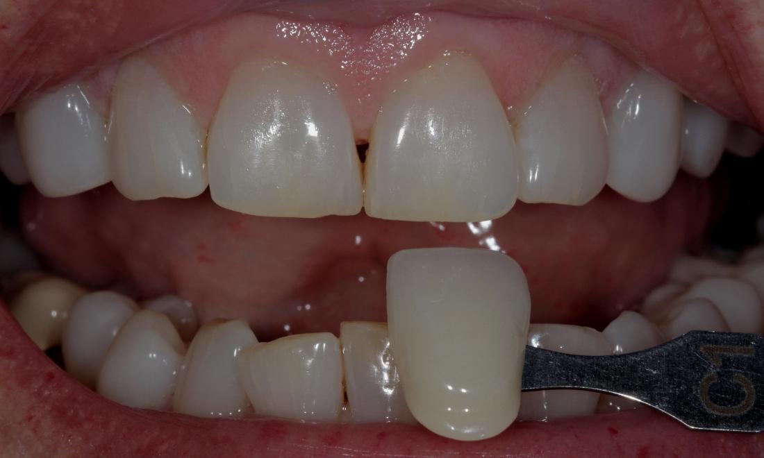 Zoom! Teeth Whitening Before | Cook Family & Cosmetic Dentistry | Birmingham, AL