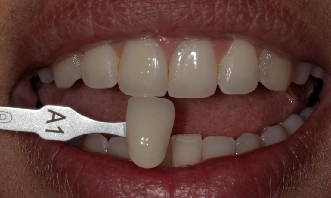 before teeth whitening | Cook Family & Cosmetic Dentistry | Birmingham, AL