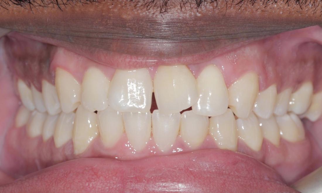 Before Clear Correct - crooked teeth | Cook Family & Cosmetic Dentistry | Birmingham, AL