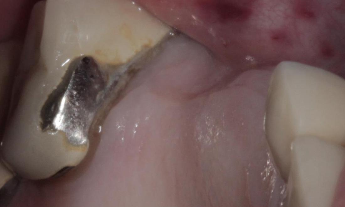 Metal filling | Cook Family & Cosmetic Dentistry | Birmingham, AL