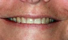 dark, stained, worn teeth | Cook Family & Cosmetic Dentistry | Birmingham, AL