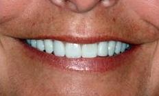 Whitened, brightened teeth | Cook Family & Cosmetic Dentistry | Birmingham, AL