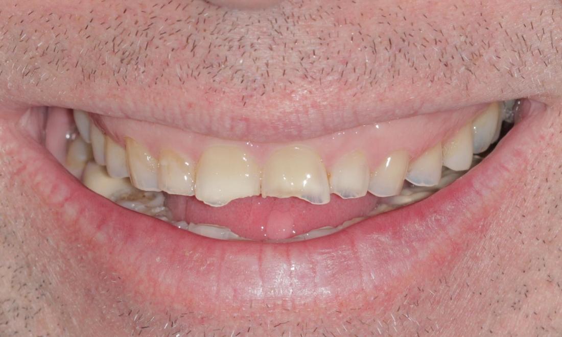 Chipped, broken teeth before | Cook Family & Cosmetic Dentistry | Birmingham, AL
