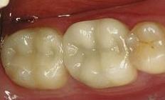 Replaced white filling | Cook Family & Cosmetic Dentistry | Birmingham, AL