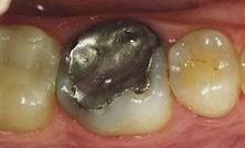Old metal filling before | Cook Family & Cosmetic Dentistry | Birmingham, AL